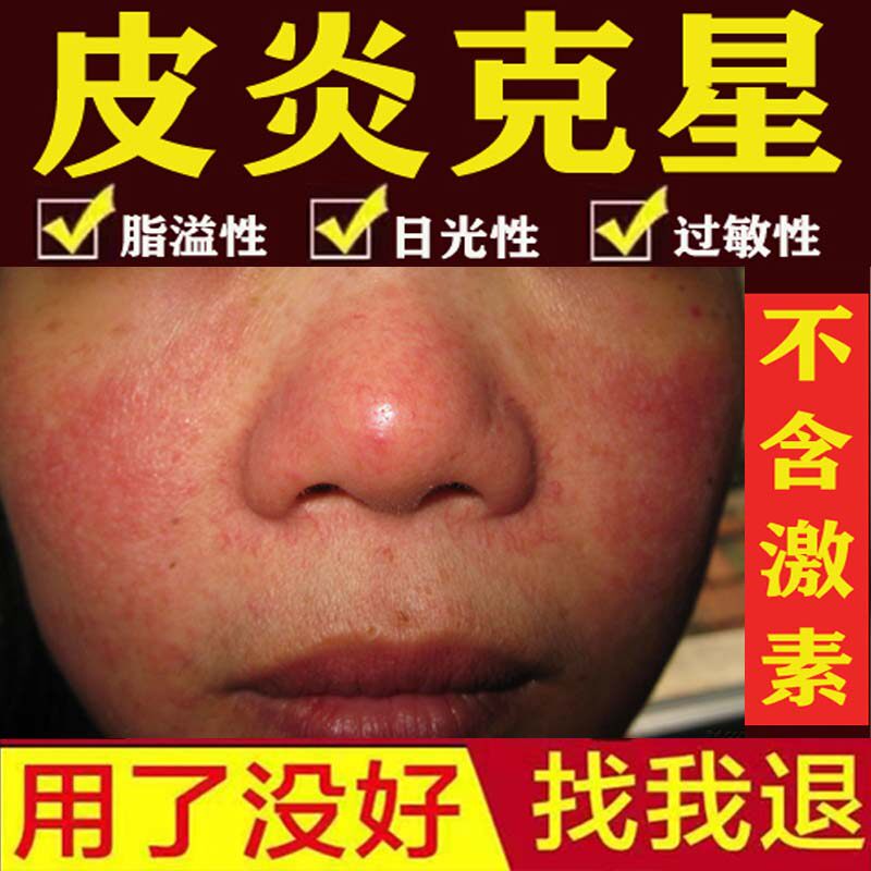 脂溢性皮炎面部无激素脸上过敏皮肤痒修复脸发红出油止痒外用