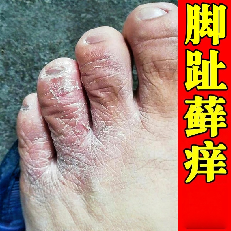 治脚趾头上长藓皮肤痒关节藓感染真菌脚面痒脚指背皮诊湿焱软膏