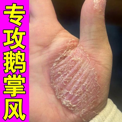 鹅掌风专用手藓膏脱皮干裂手掌心季节性脱皮角质增厚起水泡粗糙