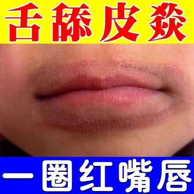 口唇焱专用唇焱唇膏嘴唇干裂脱皮修复膏用润唇膏护儿童嘴巴一圈红