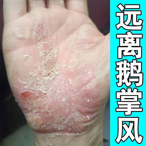 鹅掌风专用手藓膏治手上起小水泡角质层增厚粗糙开裂手足藓脱皮