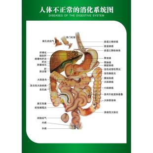 人体不正常的消化系统示意图 内脏分部图人体解剖图医院宣传挂图