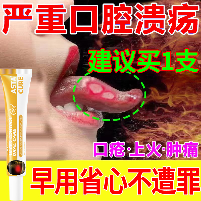 【自营】口腔溃疡一点灵药膏药贴西瓜霜专用舌头药溃疡灵口特效