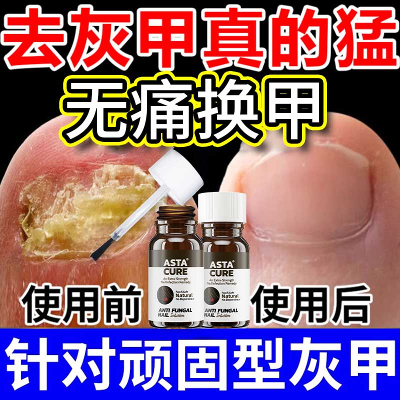 【自营】灰指甲特效药根治第一名专用药正品官方旗舰店亮治疗灰甲