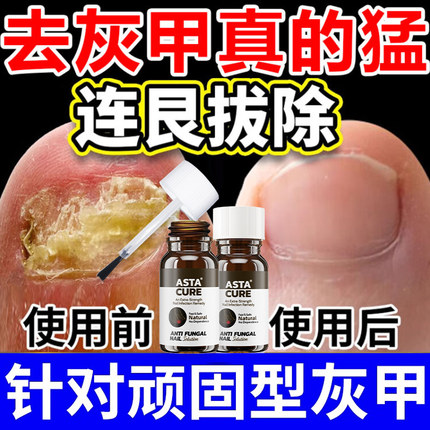 【自营】灰指甲特效药根治第一名专用药正品官方旗舰店亮治疗1甲