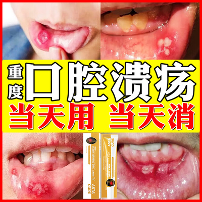【自营】口腔溃疡特效药专用药舌头一点灵凝胶贴喷剂散专用漱口水