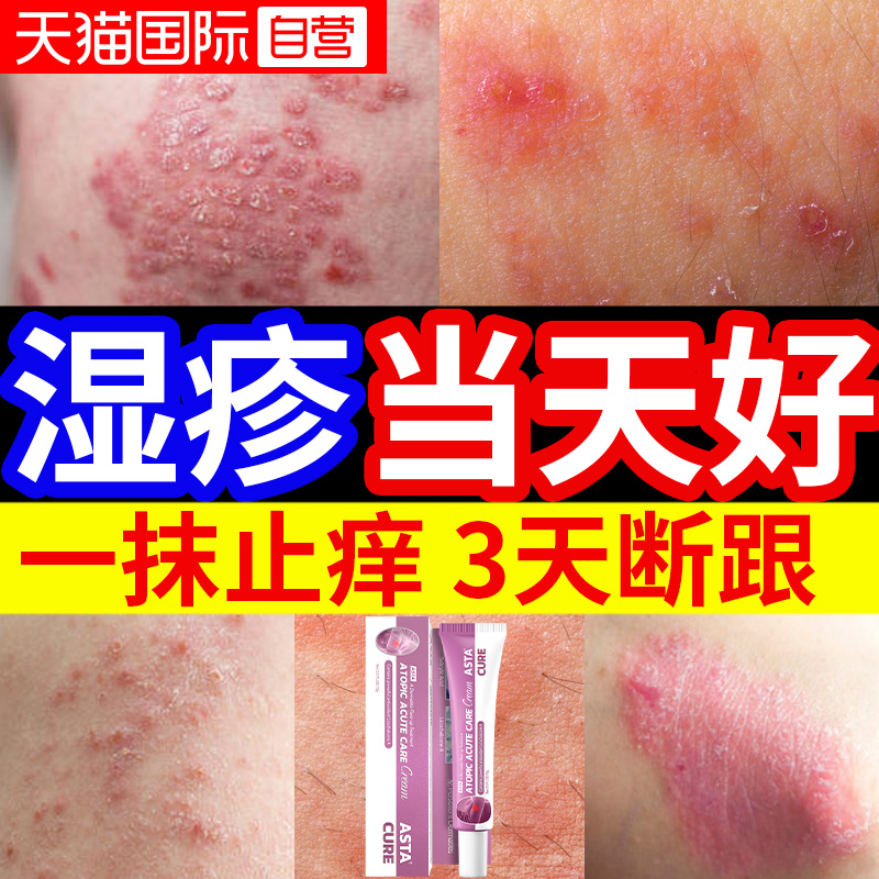 【自营】湿疹膏湿疹止痒去根外用顽固皮炎神经性汗疱疹除湿止痒膏