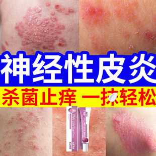 自營 神經(jīng)性皮炎濕疹藥膏止癢去根特效藥皮膚瘙癢外用頑固皮炎