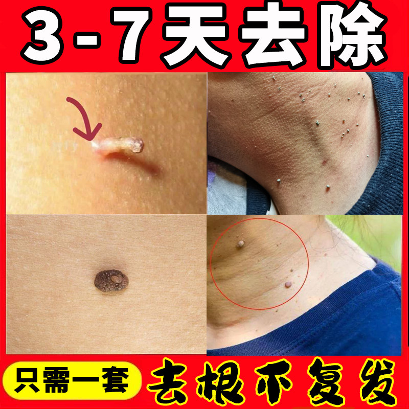 脖子上小肉球肉肉刺疙瘩赘肉丝状子去除神器腋下一抹无忧