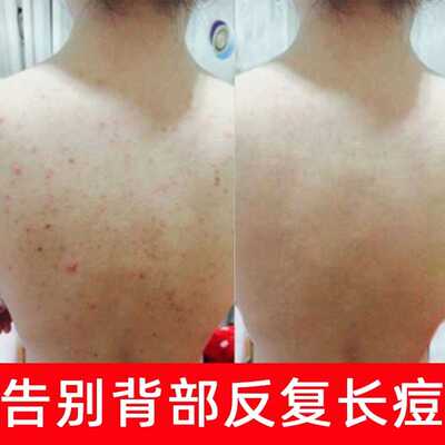 去胸口胸前背部痘痘下巴屁股身上背上长痘印粉刺螨虫后背组合套装