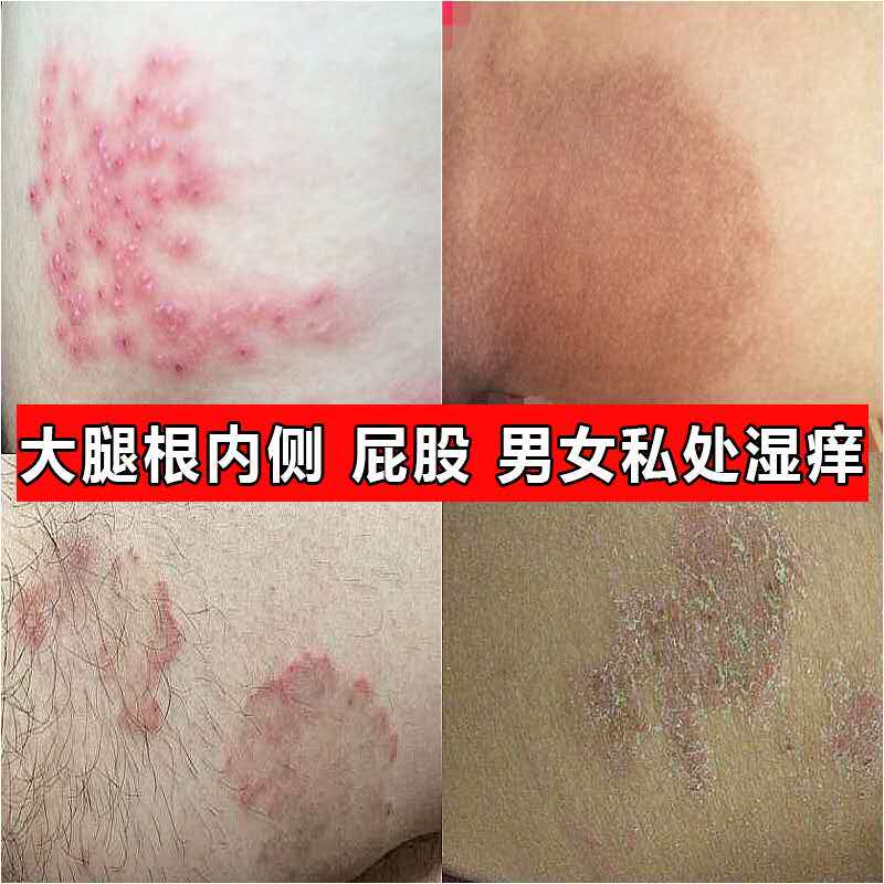 身上痒全身骚痒湿症痒手足牛皮鲜皮肤痒过敏肛门外阴私处痒外用