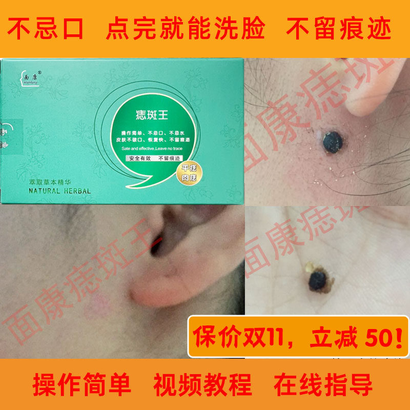 面康痣斑王点痣膏正品去痣点痦子祛痣无痕点黑痣红痣老年斑神器