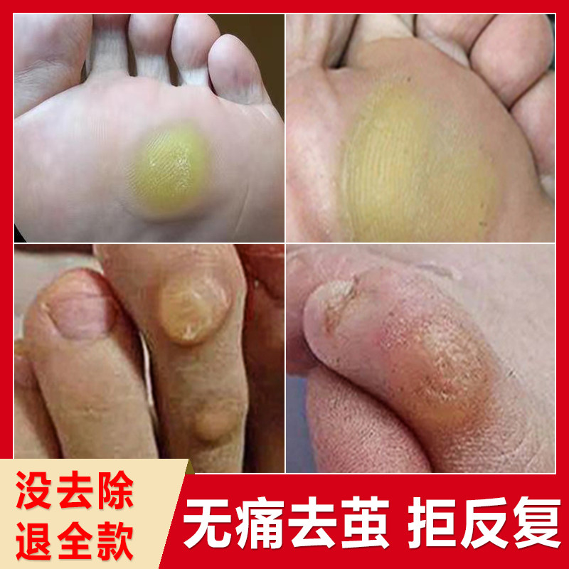老茧去除软化剂去手上的茧子根神器祛鸡脚钉眼脚底厚脚垫贴胼胝膏