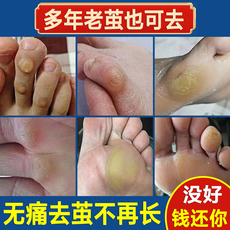 老茧去除软化剂脚茧子鸡眼膏贴祛脚底胼胝手上的死皮硬皮专用神器