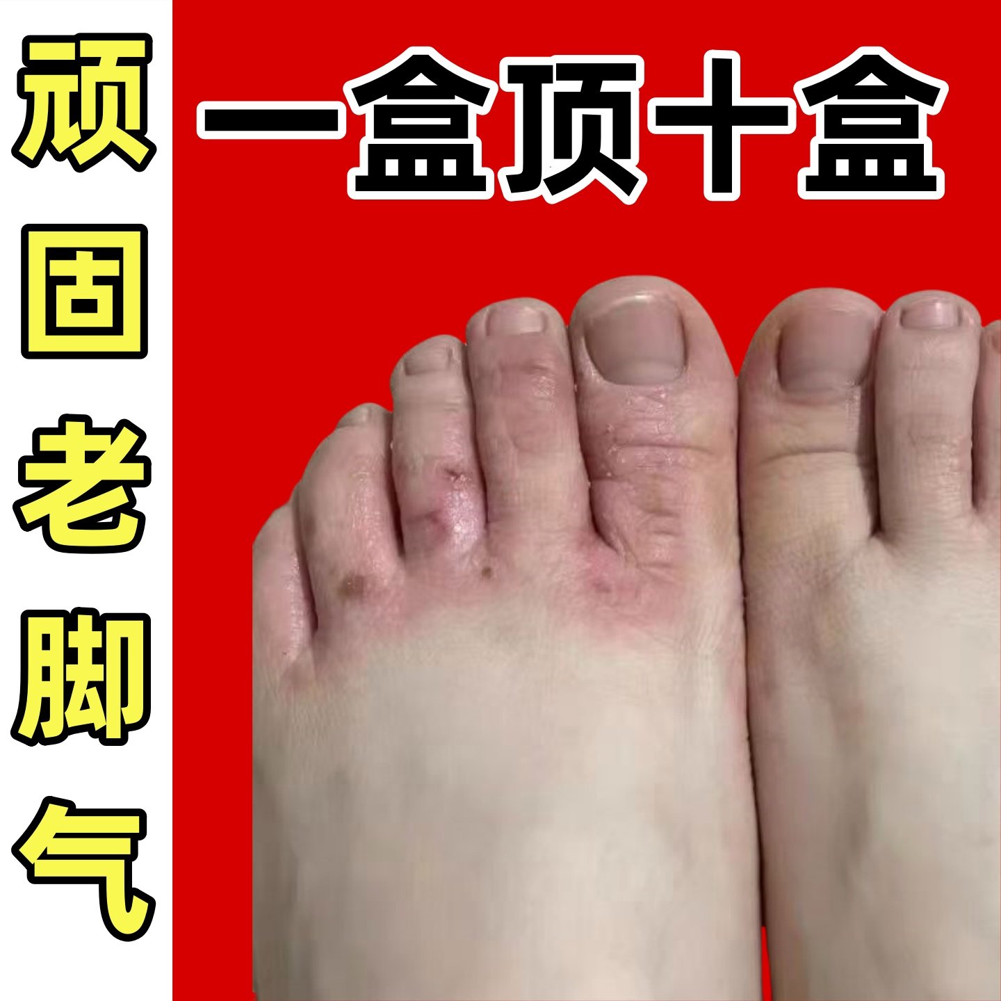 独极膏本草真菌感染脚氣真菌王止皮肤消毒护理（消）