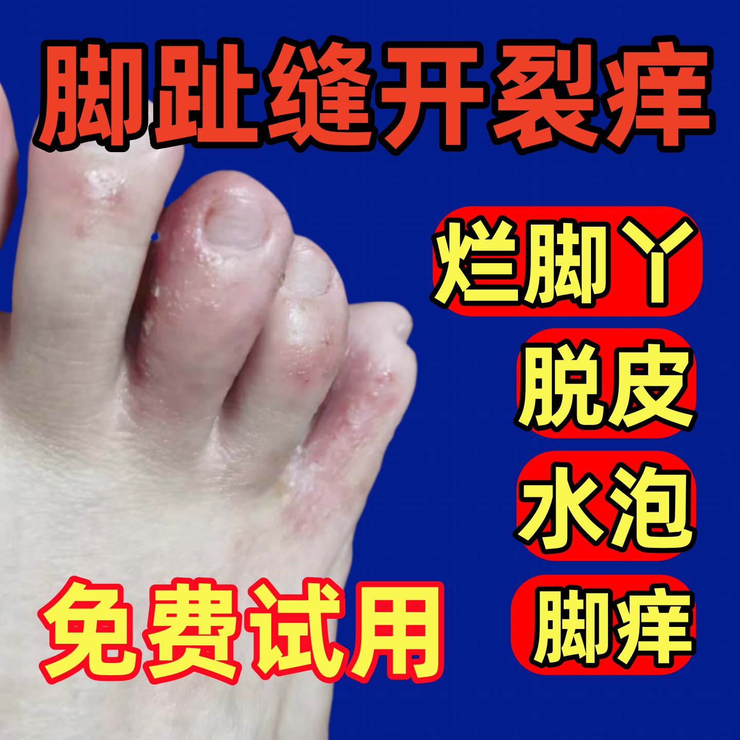 脚氣止痒脱皮杀菌烂脚丫膏糜烂脚皮肤消毒护理（消）