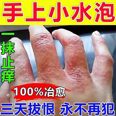 汗泡疱疹药膏手上起小水泡汗状疱疹止痒汉状真菌感染专用软膏抑菌