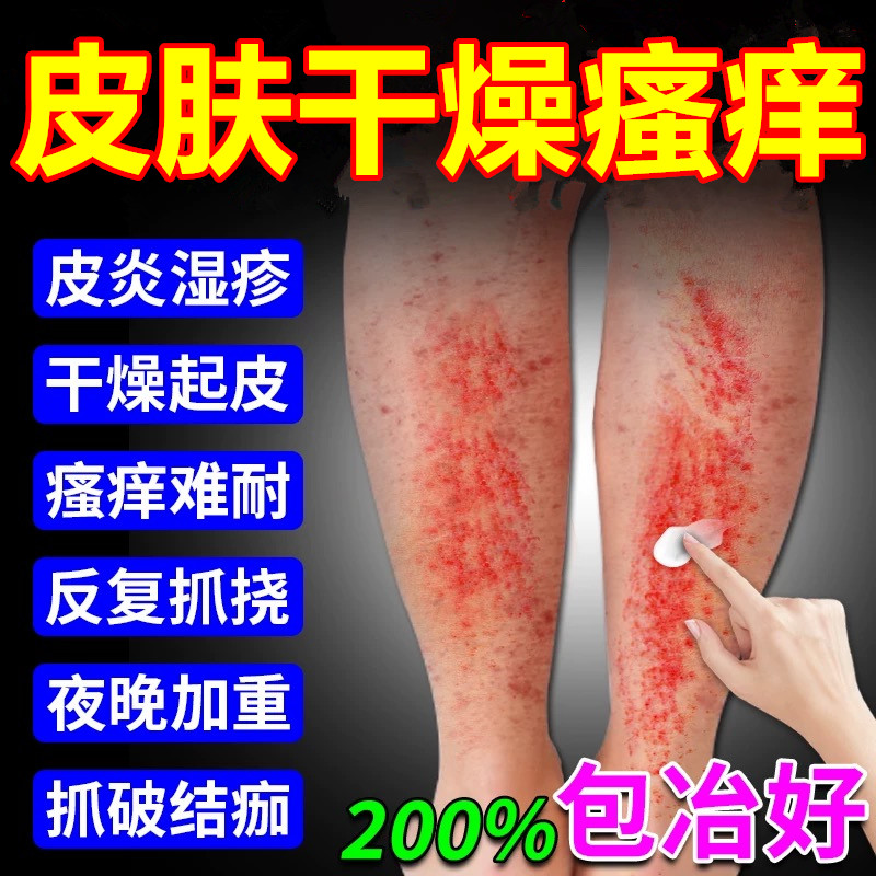 腿痒小腿皮肤干燥瘙痒止痒膏冬季皮炎起皮皮肤瘙痒外用的特效药膏