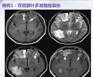2026神经系统MRI磁共振解剖疾病视频课