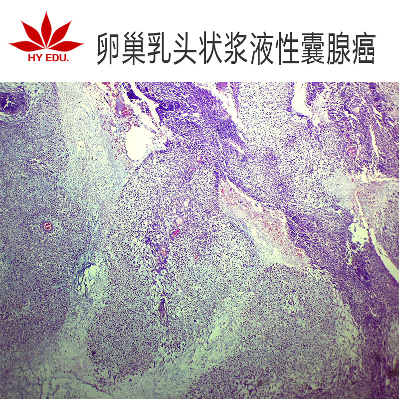卵巢乳头状浆液性囊腺癌生物切片玻璃制高教教学成像清晰