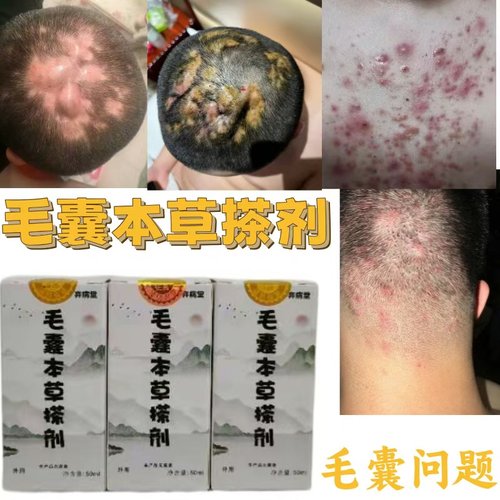 【中医推荐】外用毛囊本草搽剂