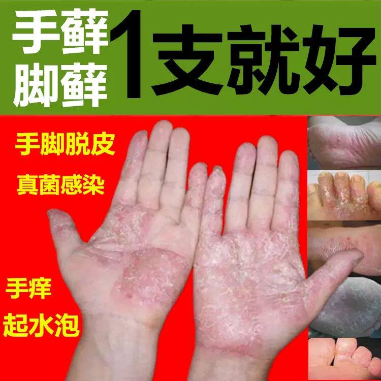 手癣膏手足癣真菌感染脱皮干裂水泡湿疹股藓皮肤病止痒去根脚癣膏|ruв категории локализация жизни услуг, службы здравоохранения, 健康服务, 在线问诊, 内容分答 - от Buy2taobao.com для оказания профессиональной услуги покупки агента Taobao