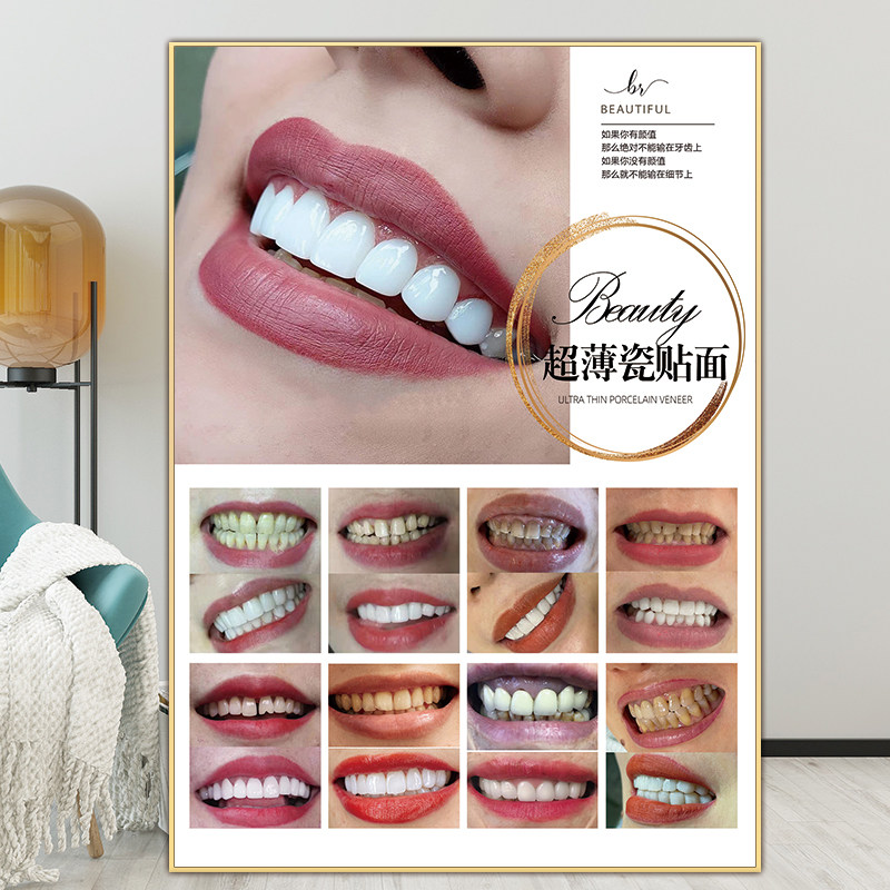 超薄瓷贴面海报牙贴面挂画牙齿美白宣传画纳米炫齿冰瓷美牙广告图