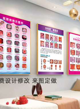 宫颈疾病示意图妇科挂画女解剖图