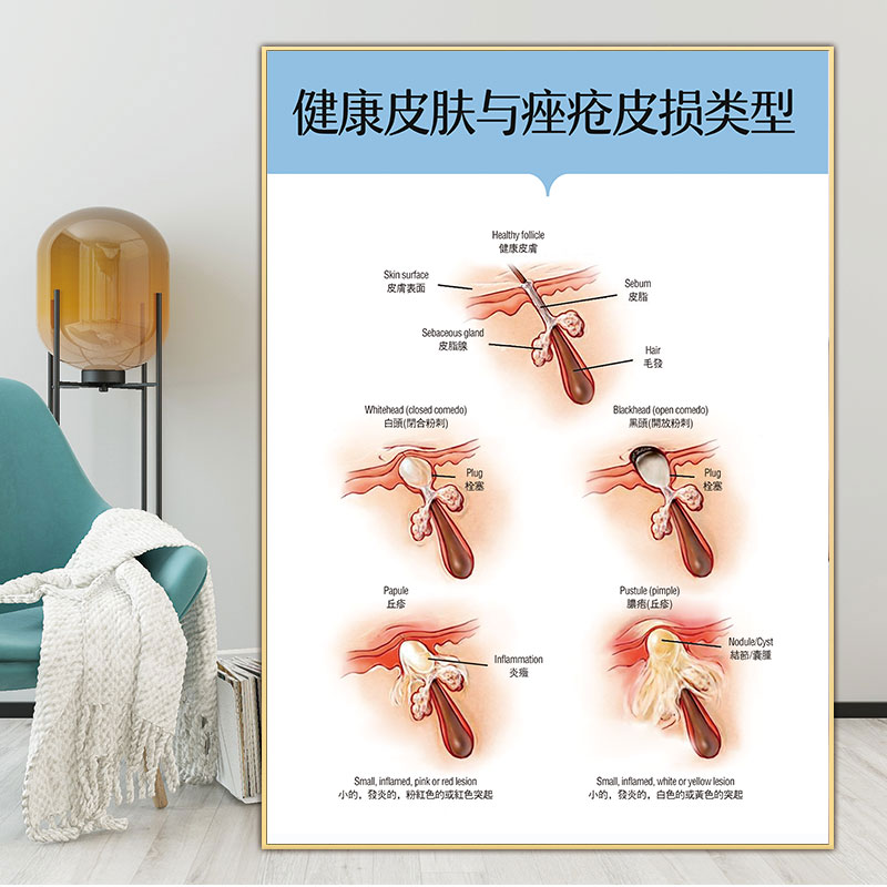 祛斑祛痘广告图色斑类型祛疤宣传画痘痘种类挂画痤疮皮损类型海报