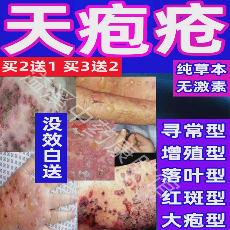 治天疱疮专用药寻常增殖落叶大疱红斑良型类天疱疮家染型外用药膏 - 小编推荐 - WePost 全民代运 - 马来西亚中国淘宝代运与集运专家