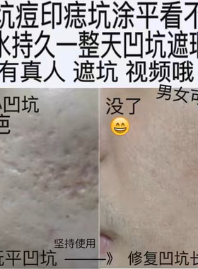 遮痘坑痘印填凹洞遮瑕膏笔痘痘凹疤痕遮盖毛孔贴男女脸部持久神器