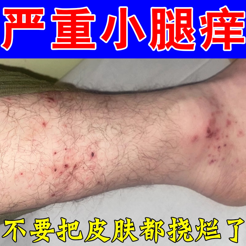 小腿痒长小红点疙瘩换季皮肤痒过敏一挠就痒腿痒干燥粗糙外用软膏