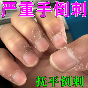 手指长倒刺修复受损营养油去倒刺神器儿童手上边缘干裂蜕皮起皮膏