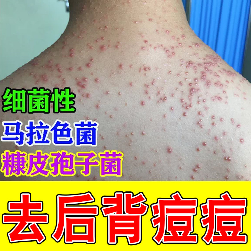 毛囊痘专用前胸后背马拉色菌糠皮孢子菌细菌性毛囊胸口痘痘草本膏