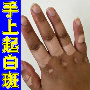 手背长白斑儿童成人肤色不均色素脱失补骨脂酊促进黑色素生长