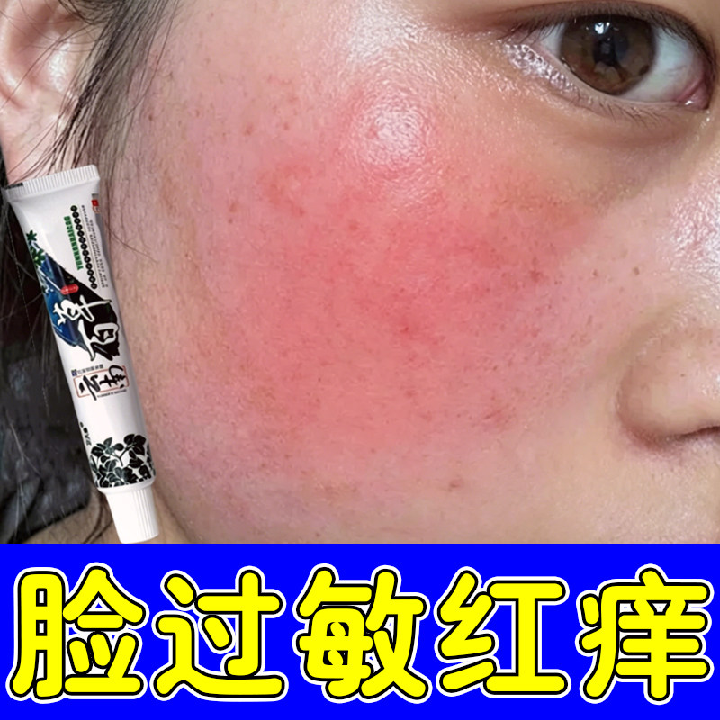 脸过敏红痒脸蛋红敏感肌泛红面部脸颊红血丝脸痒外用