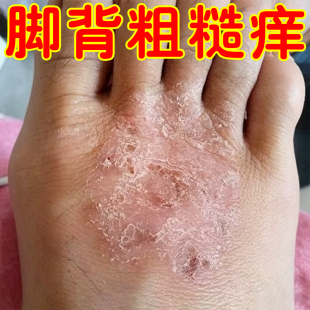 脚背粗糙痒干燥起皮掉皮屑真菌外用药脚面长小水泡脱皮干痒修复膏