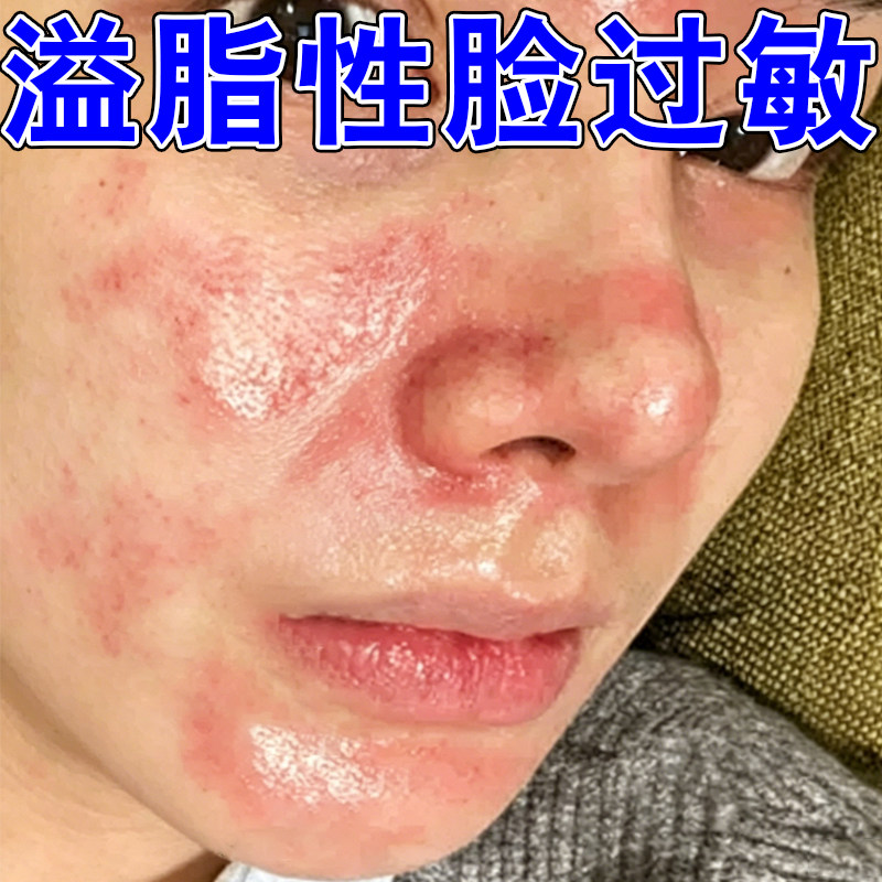 溢脂性脸过敏鼻翼两侧泛红干痒脸颊红血丝面部遇热发红发烫发热痒