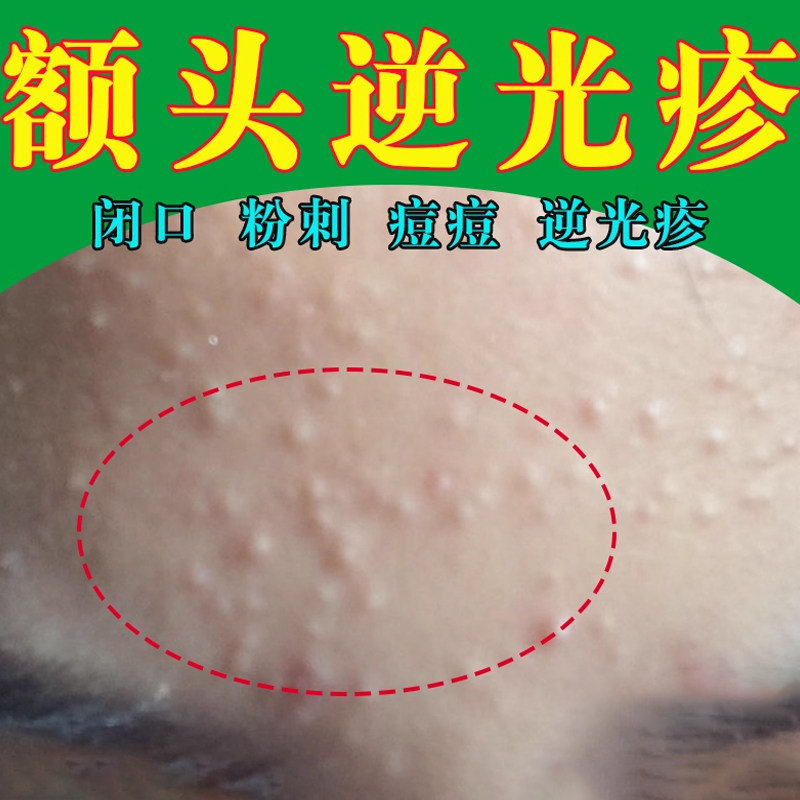 逆光疹修复脸上起小疙瘩闭口粉刺脸部逆光疹额头长小颗粒痘痘乳膏