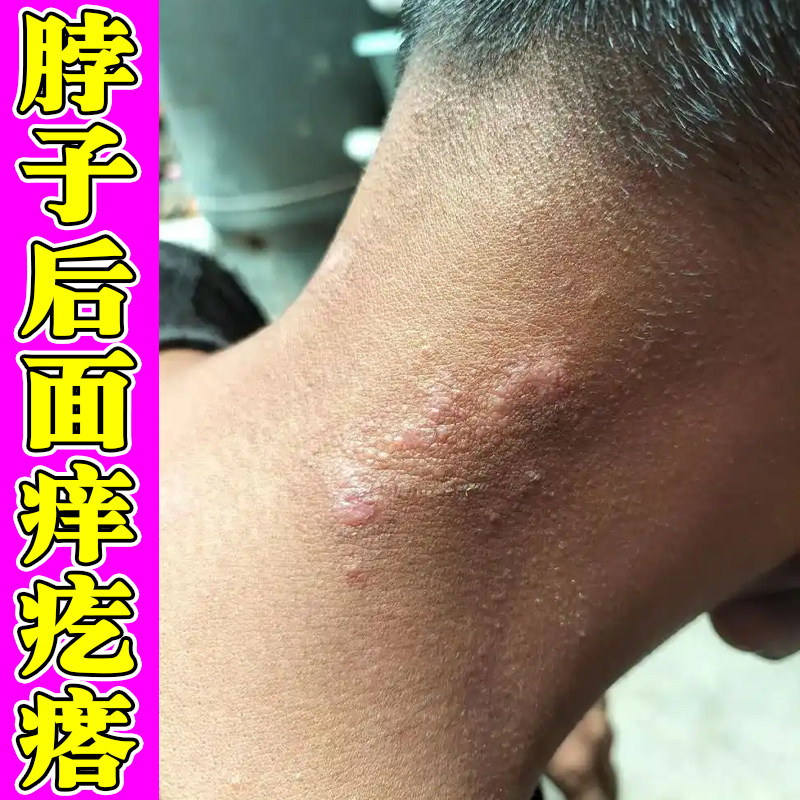 脖子后面痒长小疙瘩红痒刺挠夏天脖子痒出汗一挠就痒外用软膏