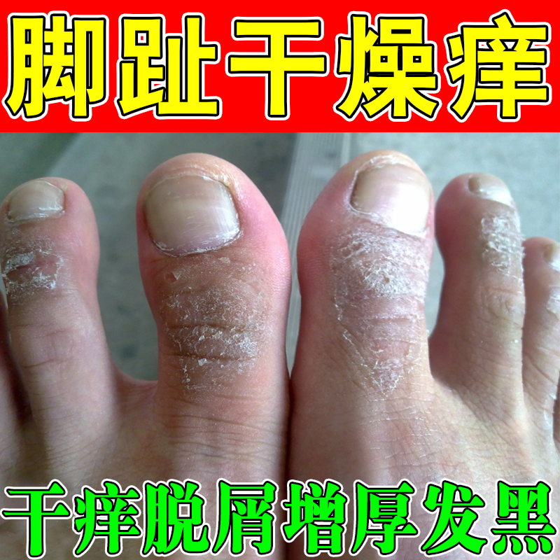 脚趾头干燥痒脚背过敏干痒脚杆皮肤干燥粗糙起皮屑干痒脚痒外用膏