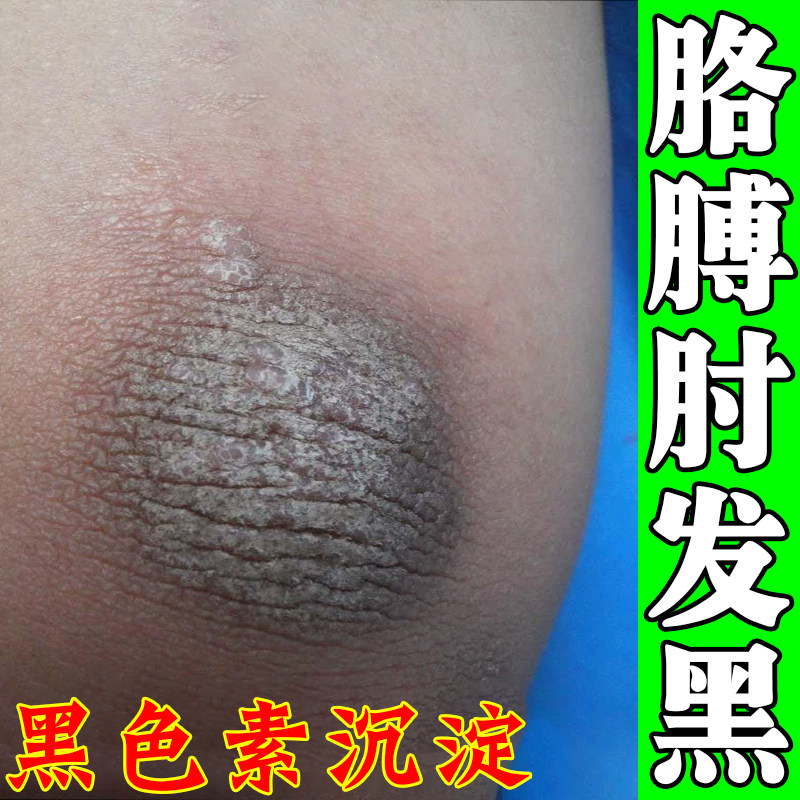 去胳膊肘黑皮肤脖子黑色素沉淀手肘关节黑棘皮死皮角质磨砂膏神器