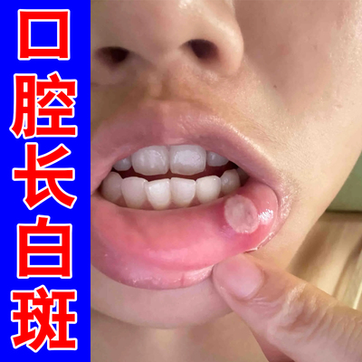 嘴巴内壁长白斑红肿灼热疼痛破口儿童成人上火嘴巴起白泡外用喷剂