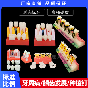 牙科模型 4倍种植解义齿修复种植牙解说可拆卸连桥牙冠牙齿龋齿牙