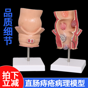 直肠病理模型痔疮病变解剖模型