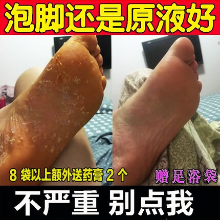 刘先生助康护理贡卡姆桑液去手足汗痒异味脚水泡脱皮干裂送泡脚袋