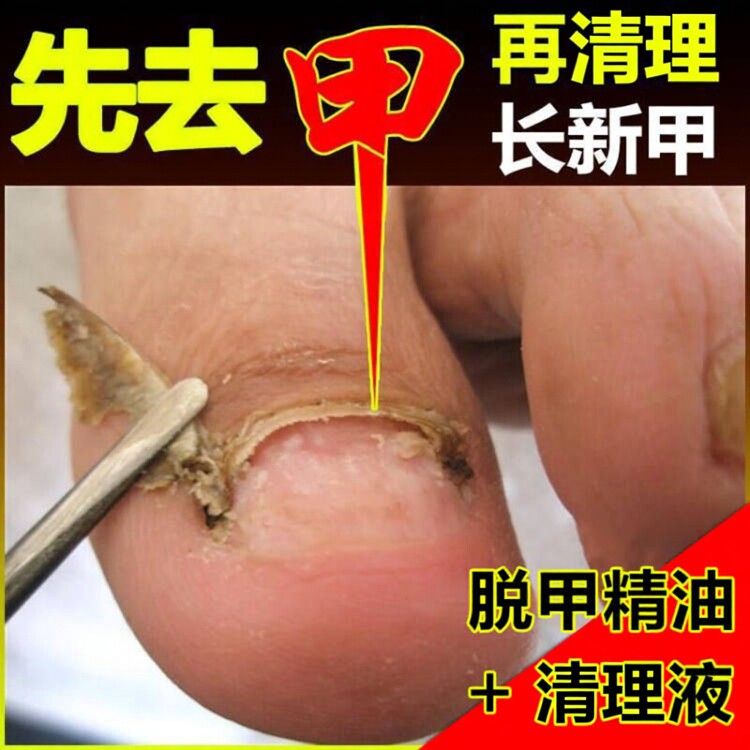 灰厚甲增厚脱甲液软甲膏灰厚甲清去除手脚发黄厚指甲新亮灰厚甲净
