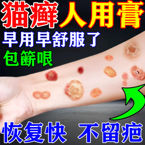 人用猫藓药猫藓外用人得猫癣专用药人感染真菌皮肤病止痒治疗药膏