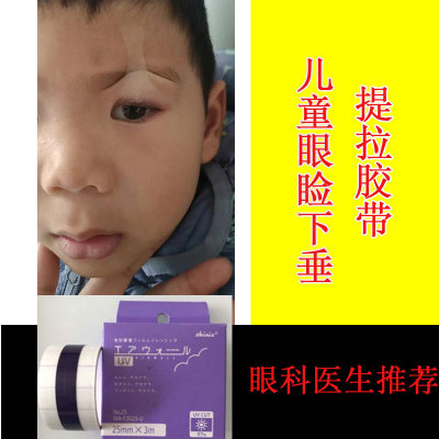 宝宝上眼睑重症肌无力下垂贴矫正