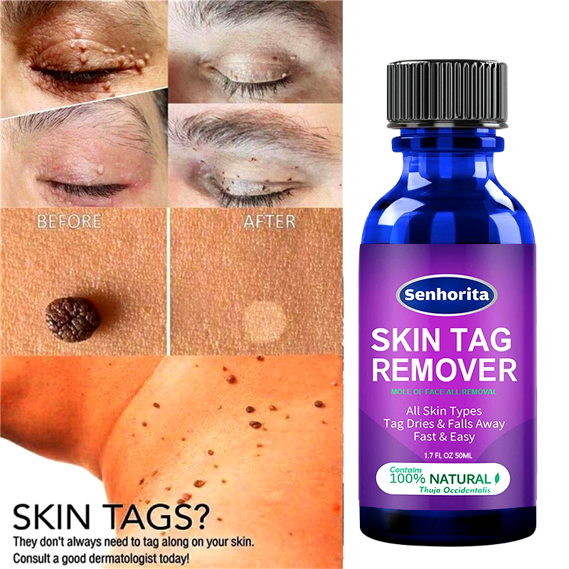 SkinTagRemoverAtMol
